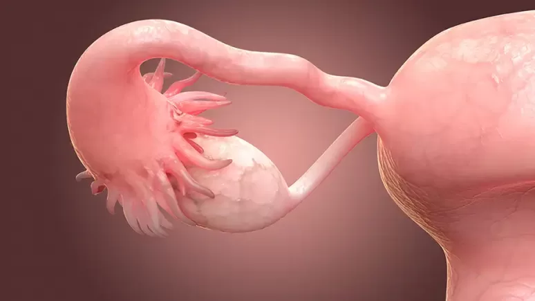 tubo-ovarian cancer